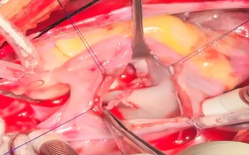 جراحو قصر العيني ينجحون في استئصال ورم قلب طفل دون مساس بالصمام